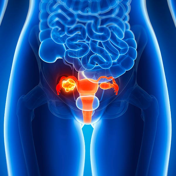 Histerectomía laparoscópica