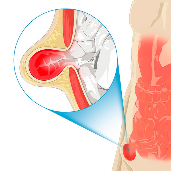 Plastia inguinal por laparoscopía